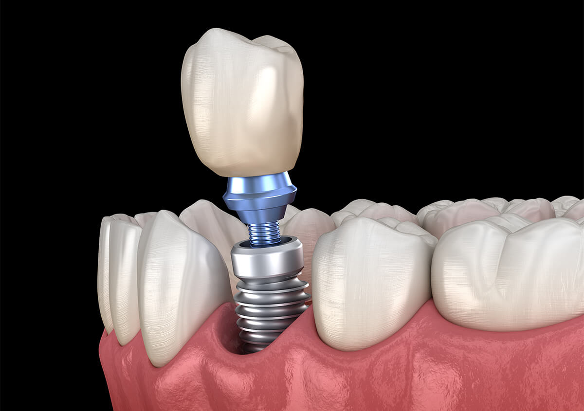 Types of Dental Implants in Streamwood IL Area